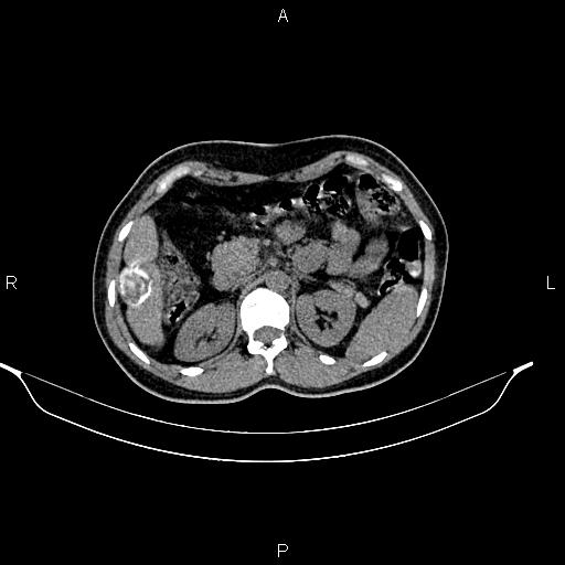 File:Calcified hepatic hydatid cyst (Radiopaedia 84672-100095 Axial non-contrast 36).jpg