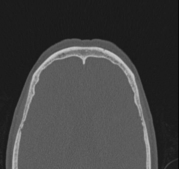 Caldwell-Luc operation (Radiopaedia 52329-58225 Axial bone window 9).jpg