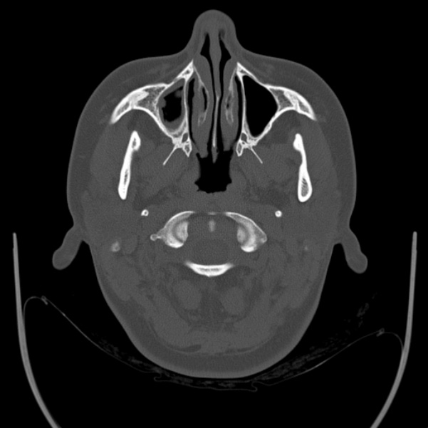 Calvarial osteoma (Radiopaedia 36520-38079 Axial bone window 7).jpg