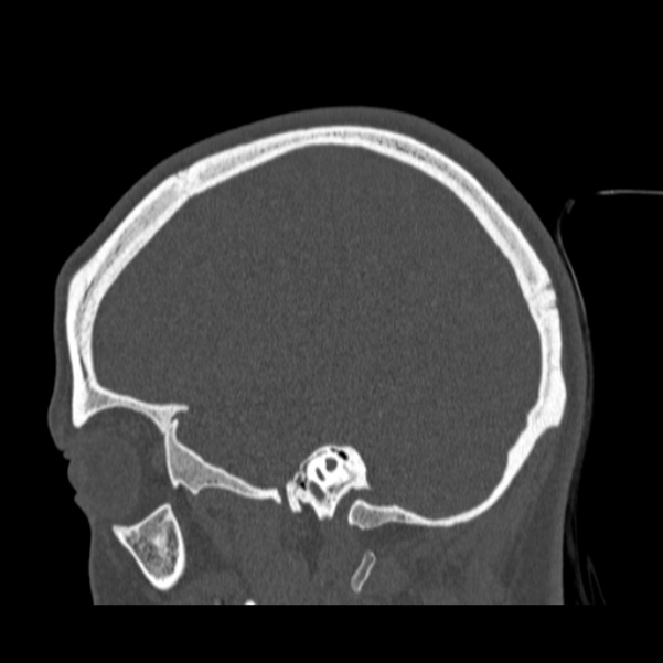 Calvarial osteoma (Radiopaedia 36520-38079 Sagittal bone window 34).jpg