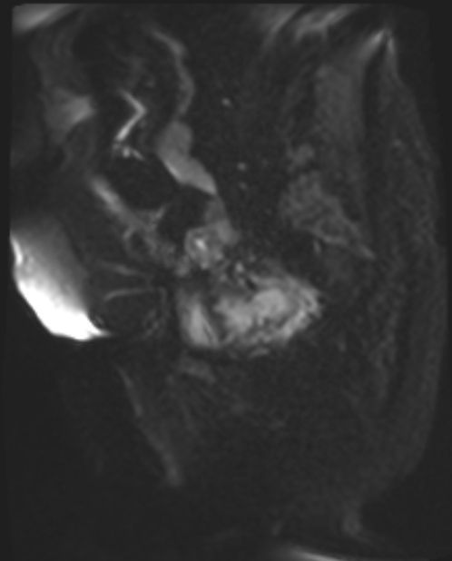 Cancer cervix - stage IIb (Radiopaedia 75411-86615 Sagittal DWI 30).jpg