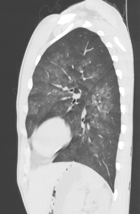 Cannabis-induced diffuse alveolar hemorrhage (Radiopaedia 89834-106946 Sagittal lung window 102).jpg