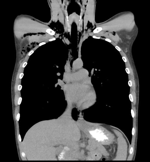 File:Cannabis ('bong') smoking induced pneumomediastinum and subcutaneous emphysema (Radiopaedia 29947-30479 D 23).jpg