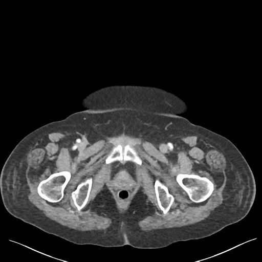 Cannonball metastases from endometrial cancer (Radiopaedia 42003-45031 E 77).png