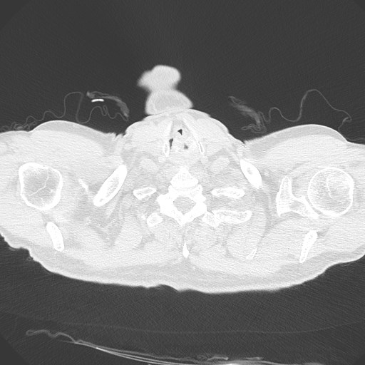 Caplan syndrome (Radiopaedia 56667-63530 Axial lung window 9).jpg
