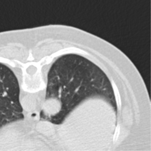 File:Carcinoid tumor - lung (Radiopaedia 44814-48644 Axial lung window 95).png