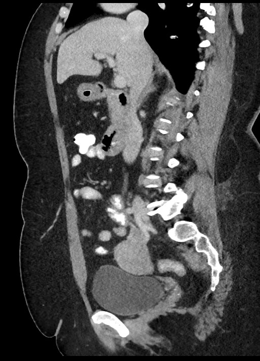 Carcinoid tumor - terminal ileum (Radiopaedia 60931-68739 C 57).jpg