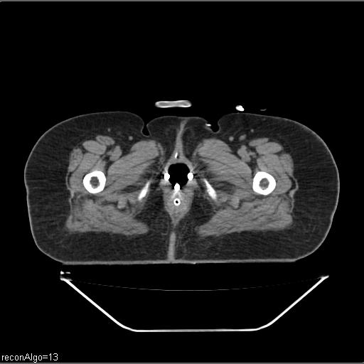 File:Carcinoma cervix- brachytherapy applicator (Radiopaedia 33135-34173 Axial non-contrast 53).jpg