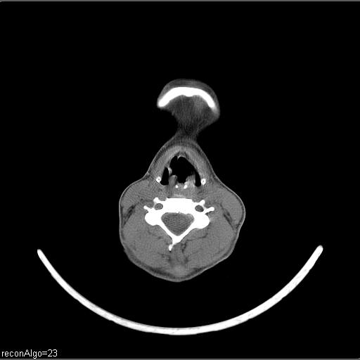 Carcinoma of the maxillary antrum (Radiopaedia 53805-59888 Axial non-contrast 28).jpg