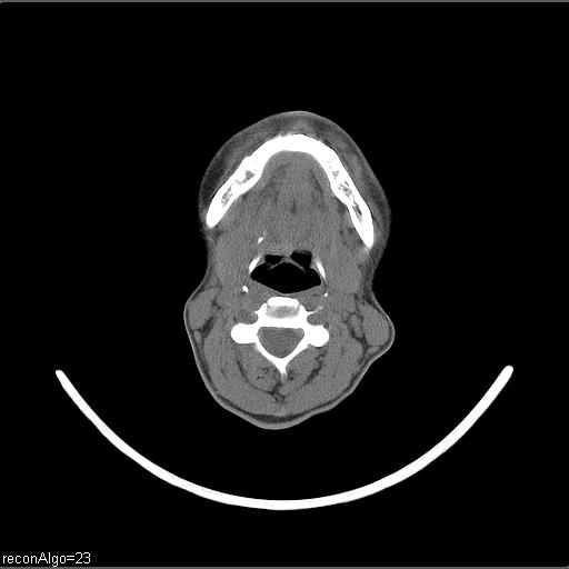 Carcinoma of the maxillary antrum (Radiopaedia 53805-59888 Axial non-contrast 36).jpg