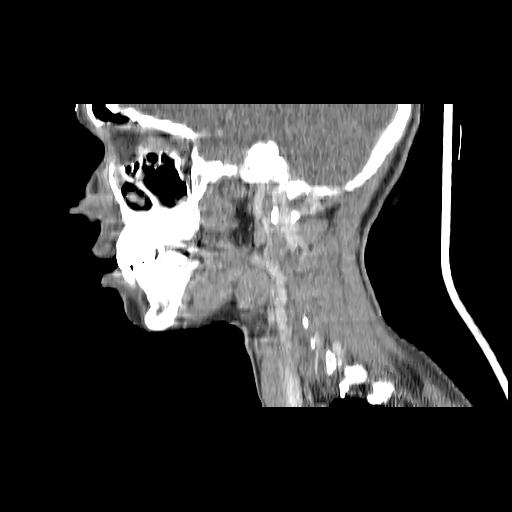Carcinoma of the maxillary antrum (Radiopaedia 53805-59888 Sagittal C+ delayed 121).jpg