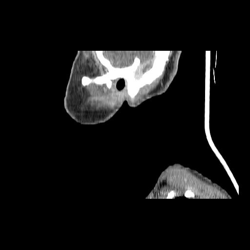 Carcinoma of the maxillary antrum (Radiopaedia 53805-59888 Sagittal C+ delayed 27).jpg