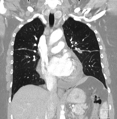 Cardiac sarcoidosis (Radiopaedia 74548-85534 Coronal lung window 31).jpg