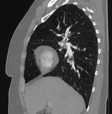 Cardiac sarcoidosis (Radiopaedia 74548-85534 Sagittal lung window 63).jpg