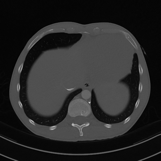 Cardiac tumor - undifferentiated pleomorphic sarcoma (Radiopaedia 45844-50134 Axial bone window 58).png