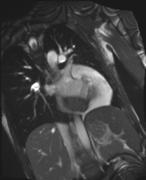 File:Cardiac tumor - undifferentiated pleomorphic sarcoma (Radiopaedia 45844-50136 Oblique T2 9).png