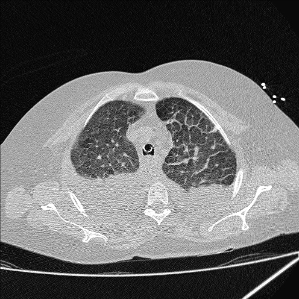 Cardiogenic pulmonary edema (Radiopaedia 29213-29609 Axial lung window 18).jpg