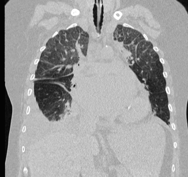 Cardiogenic pulmonary edema (Radiopaedia 29213-29609 Coronal lung window 30).jpg
