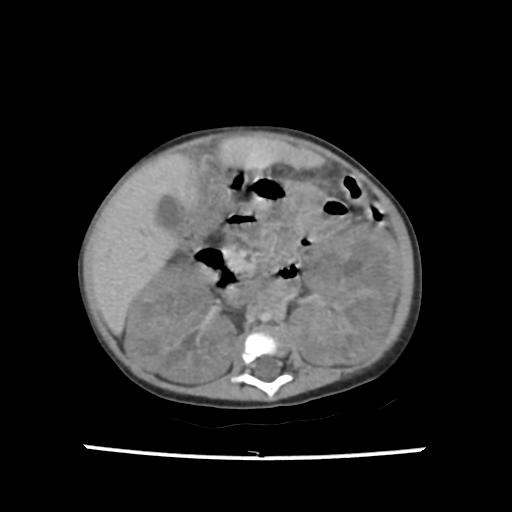File:Caroli disease with autosomal recessive polycystic kidney disease (ARPKD) (Radiopaedia 89651-106703 B 110).jpg