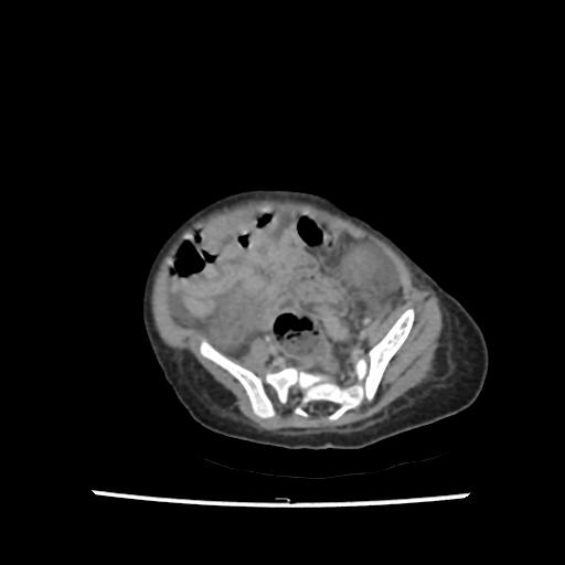 File:Caroli disease with autosomal recessive polycystic kidney disease (ARPKD) (Radiopaedia 89651-106703 B 180).jpg