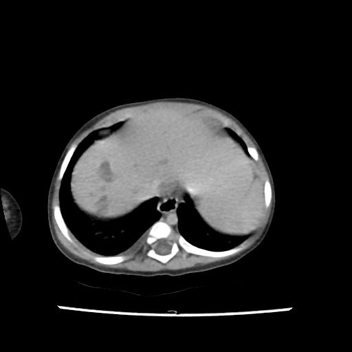 File:Caroli disease with autosomal recessive polycystic kidney disease (ARPKD) (Radiopaedia 89651-106703 B 20).jpg