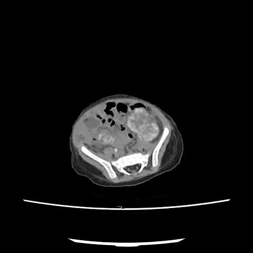 Caroli disease with autosomal recessive polycystic kidney disease (ARPKD) (Radiopaedia 89651-106703 E 182).jpg