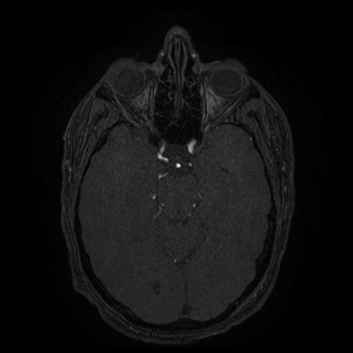Carotid arterial dissection with acute cerebral infarction (Radiopaedia 26636-26784 MRA 104).jpg