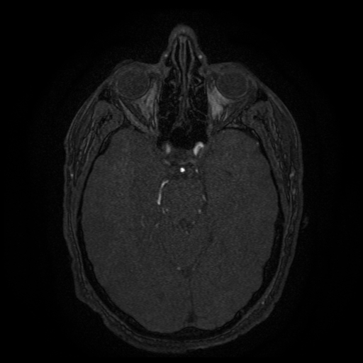 Carotid arterial dissection with acute cerebral infarction (Radiopaedia 26636-26784 MRA 106).jpg
