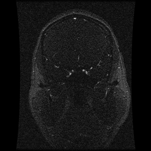 Carotid arterial dissection with acute cerebral infarction (Radiopaedia 26636-26784 MRV 112).jpg