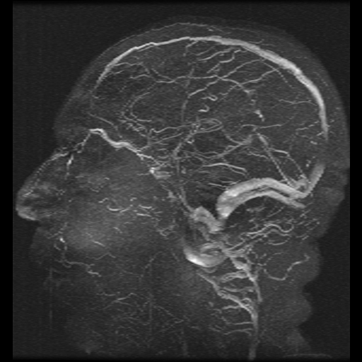Carotid arterial dissection with acute cerebral infarction (Radiopaedia 26636-26784 MRV 2).jpg