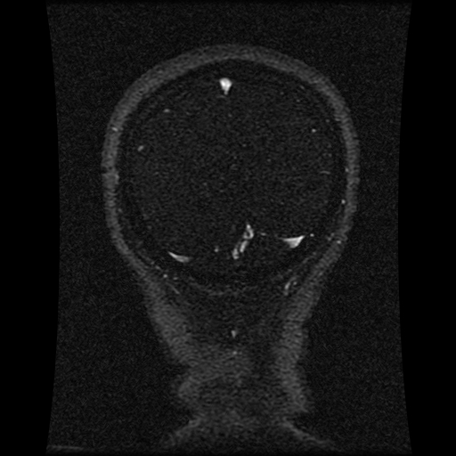 File:Carotid arterial dissection with acute cerebral infarction (Radiopaedia 26636-26784 MRV 48).jpg