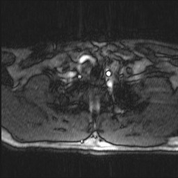 Carotid artery dissection (Radiopaedia 28441-28689 Axial MRA 7).jpg