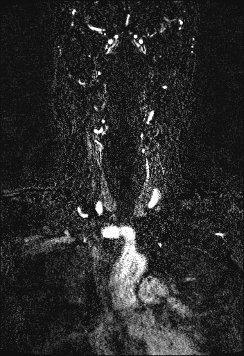 Carotid artery dissection (Radiopaedia 28441-28689 Coronal MRA 27).jpg