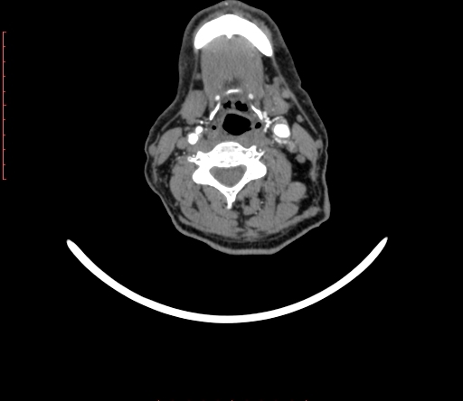 Carotid body tumor (Radiopaedia 66785-76116 B 54).jpg