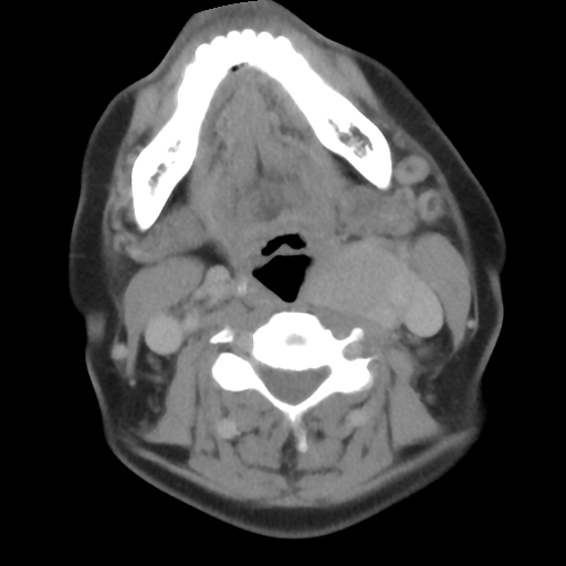 Carotid body tumor (paraganglioma) (Radiopaedia 38586-40729 A 54).jpg