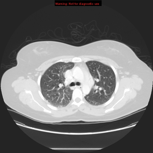 Carotid body tumor with lung metastases (Radiopaedia 9301-48390 Axial lung window 28).jpg