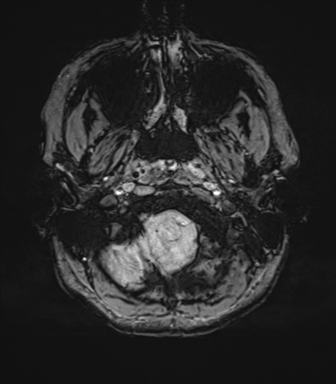 File:Cavernoma with bleed - midbrain (Radiopaedia 54546-60773 Axial SWI 6).png