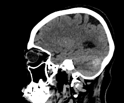 Cavernous hemangioma of the cerebellar falx (Radiopaedia 73025-83723 B 105).jpg