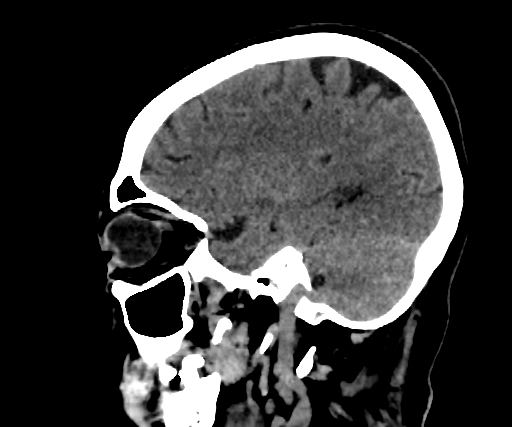 Cavernous hemangioma of the cerebellar falx (Radiopaedia 73025-83723 B 231).jpg