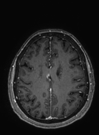 File:Cavernous hemangioma of the cerebellar falx (Radiopaedia 73025-83724 Axial T1 C+ 105).jpg