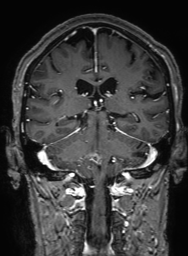 Cavernous hemangioma of the cerebellar falx (Radiopaedia 73025-83724 Coronal T1 C+ 233).jpg
