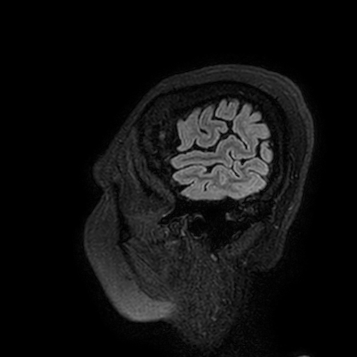 Cavernous hemangioma of the cerebellar falx (Radiopaedia 73025-83724 Sagittal FLAIR 204).jpg