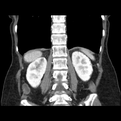 Cavernous hepatic hemangioma (Radiopaedia 75441-86667 C 107).jpg