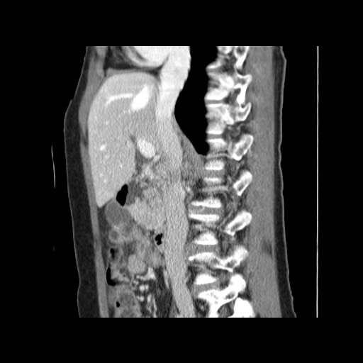 Cavernous hepatic hemangioma (Radiopaedia 75441-86667 D 84).jpg