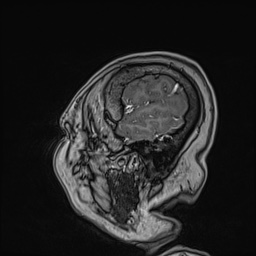 Cavernous sinus meningioma (Radiopaedia 63682-72367 Sagittal T1 C+ 148).jpg