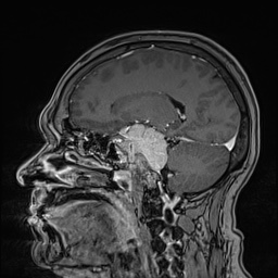 Cavernous sinus meningioma (Radiopaedia 63682-72367 Sagittal T1 C+ 78).jpg