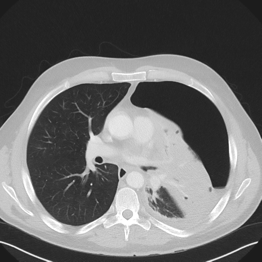 File:Cavitating pneumonia complicated by pneumothorax (Radiopaedia 48149-52994 Axial lung window 34).png