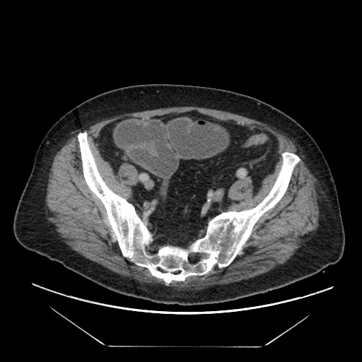 Cecal adenocarcinoma (Radiopaedia 64871-73817 A 76).jpg