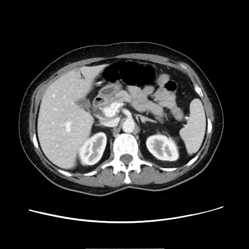 Cecal adenocarcinoma (Radiopaedia 75909-87331 A 31).jpg
