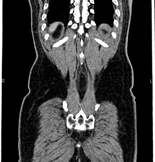Cecal adenocarcinoma (Radiopaedia 85324-100916 D 62).jpg